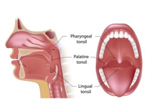 Pros and cons of getting your tonsils removed